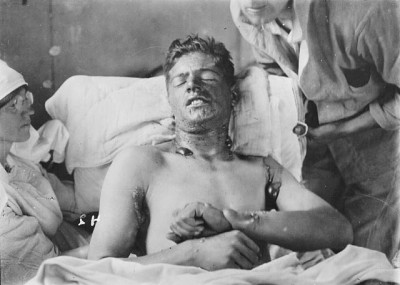A Canadian victim of mustard gas at No.7 Canadian General Hospital, Etaples, c. 1917 (Library and Archives Canada/ Wikimedia).